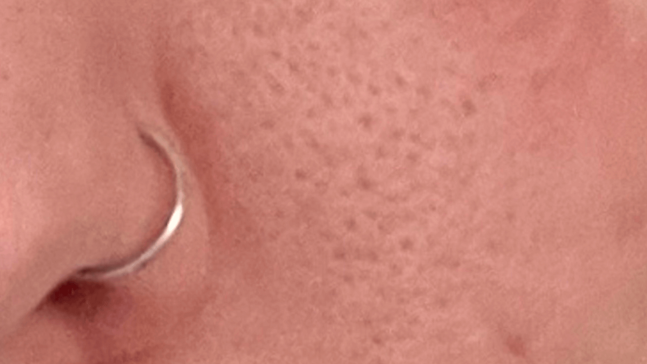 beforepores